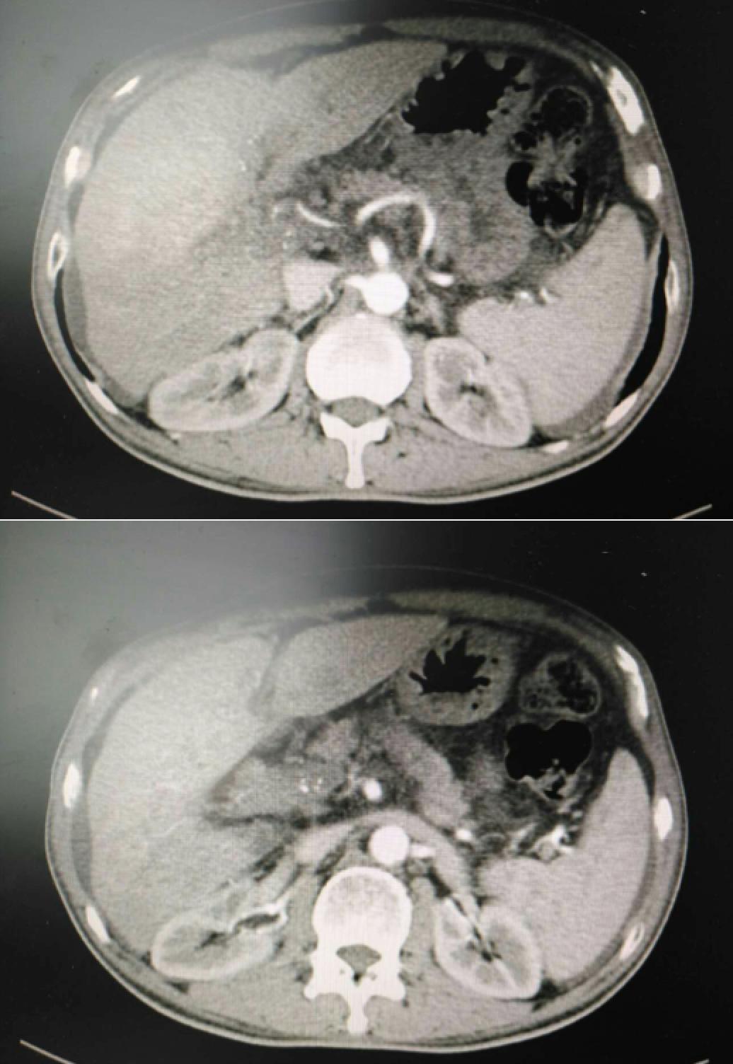 肝癌病例实例100例,肝癌的治疗方法论文