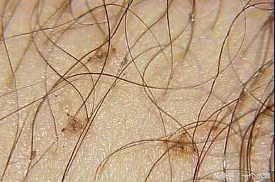 你对虱子和虮子只停留在上世纪六七十年代吗?国外现在还有