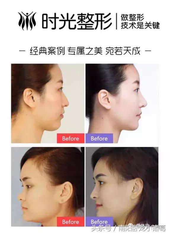 假体在鼻子里能保持一辈子吗,鼻子假体时间长会缩小还是会膨胀