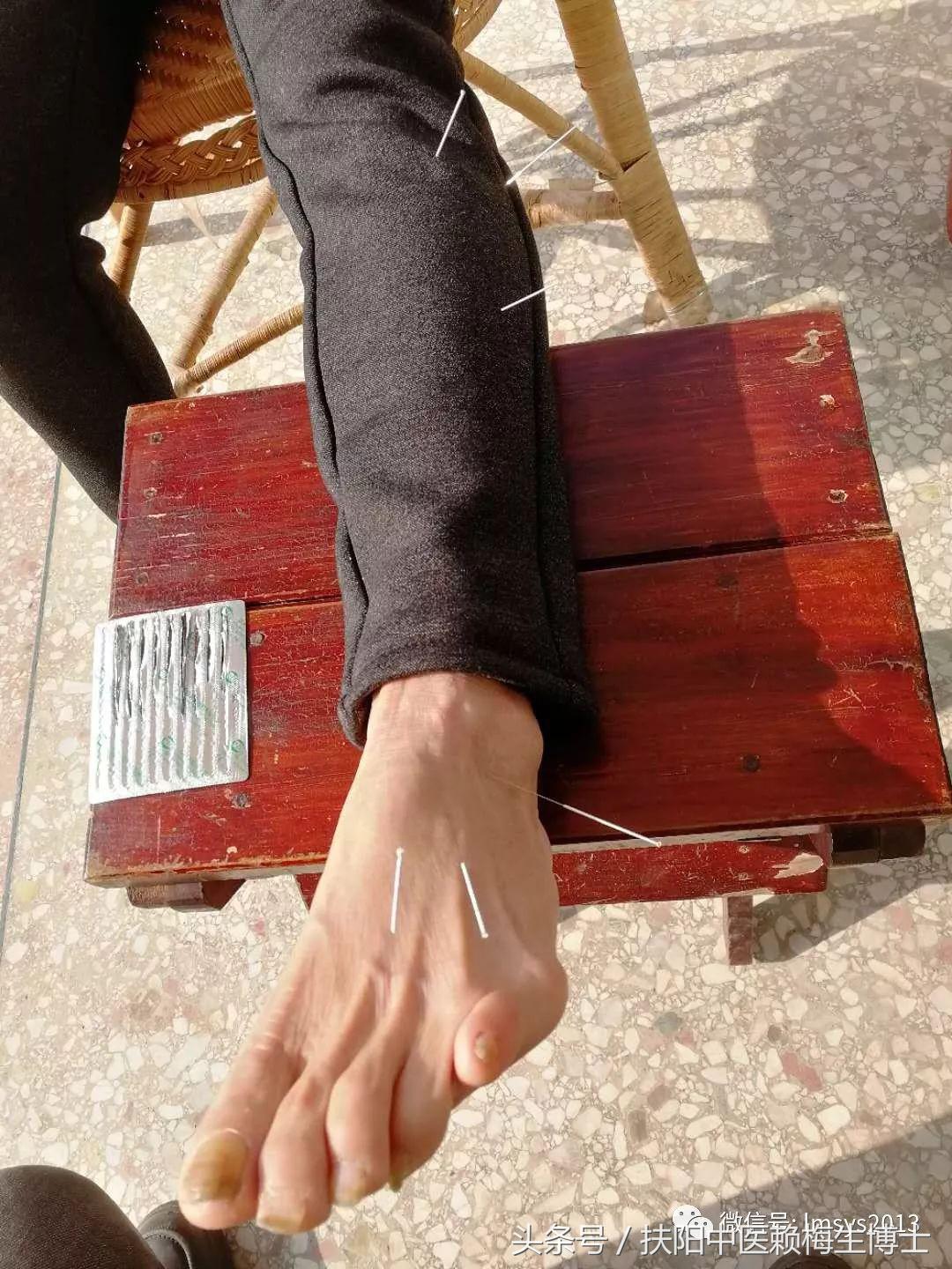 内针治疗带状疱疹剧烈疼痛4例分析