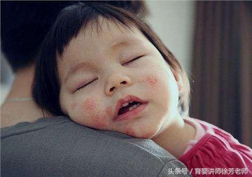 宝宝换奶粉后身上起红疹,宝宝换奶粉身上起红点怎么办