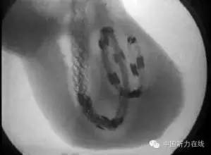 得了神经性耳鸣怎么办,治疗神经性耳鸣的音乐