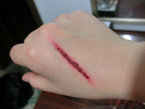 伤口感染艾滋病毒的条件,伤口感染艾滋病的条件有哪些