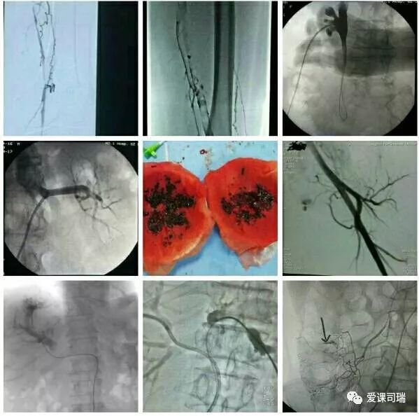 爱课敲板｜有关介入，看看你都了解了吗？