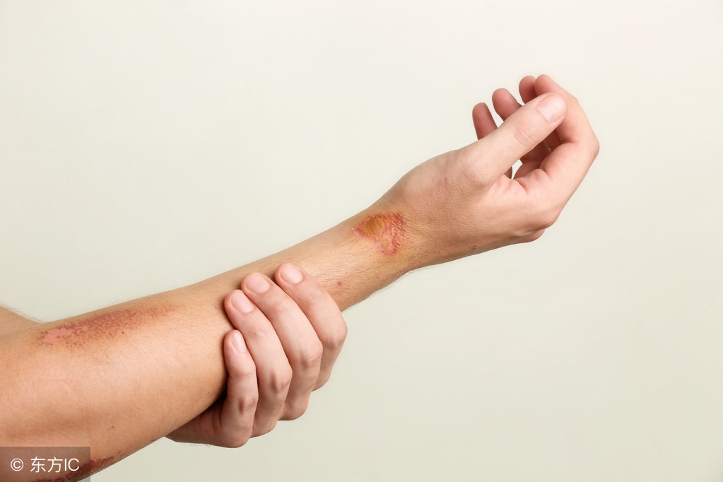 小刀划破手指要打破伤风吗,手被小刀划破了不停的流血怎么办