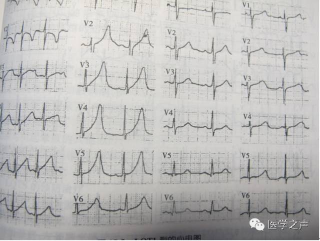 心电图显示t波高尖qt间期延长,心电图显示qt间期延长怎么回事