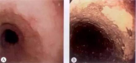 早期食管癌用内镜可以根除吗,超声内镜可以查出早期食管癌吗