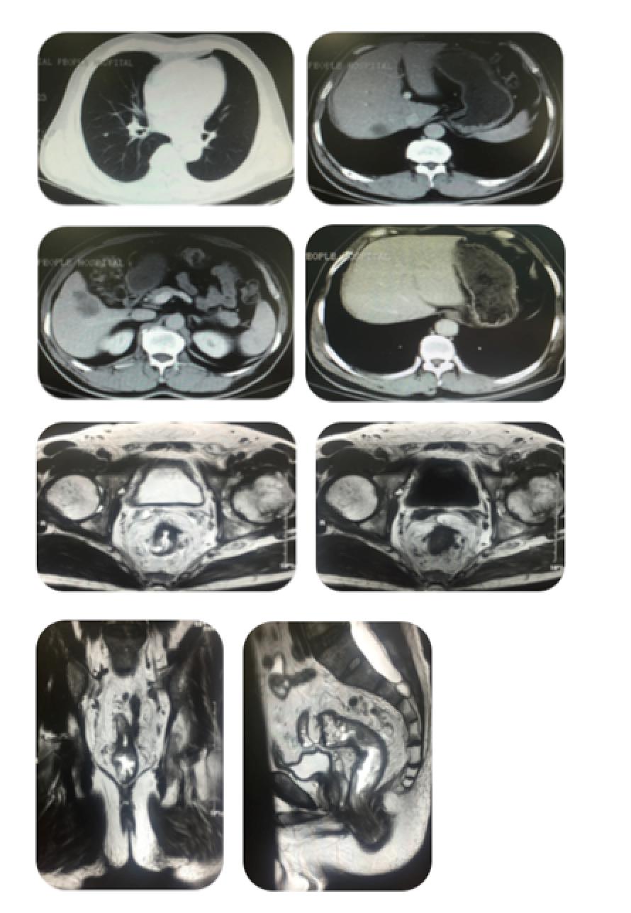 直肠癌肺转移多发治疗方案,直肠癌转移治愈病例