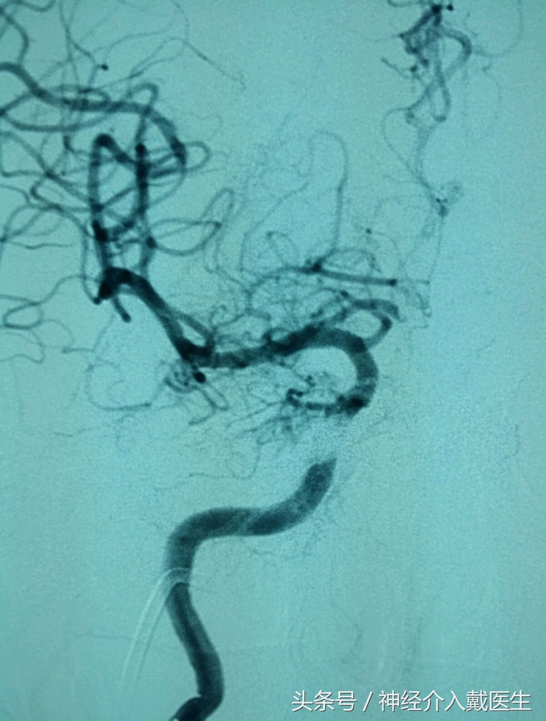 颅内高频声,听到颅内有咯噔声是什么原因