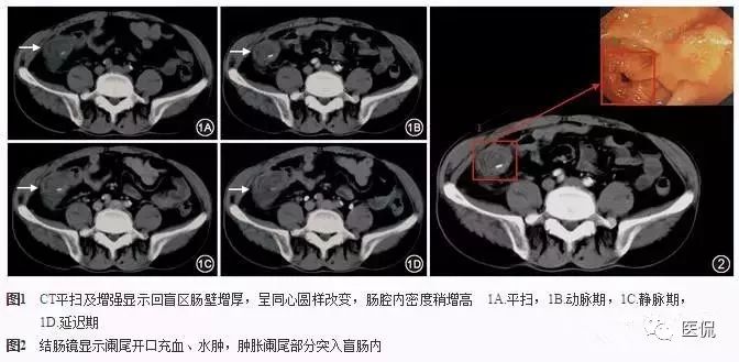 阑尾炎特殊检查讲解视频,阑尾炎病例分析的模板