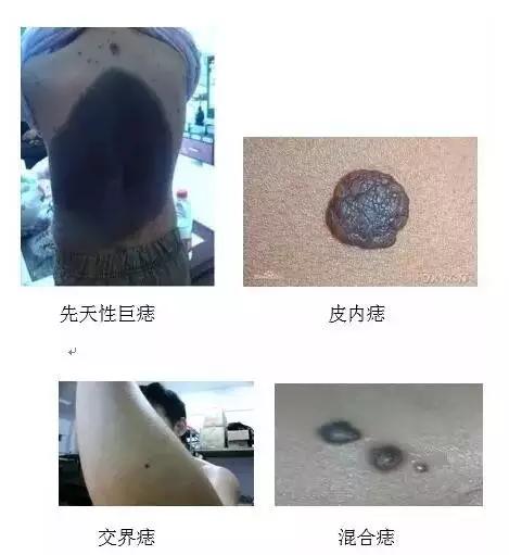 身上的大黑痣有可能癌变吗,身上的黑痣有药治吗