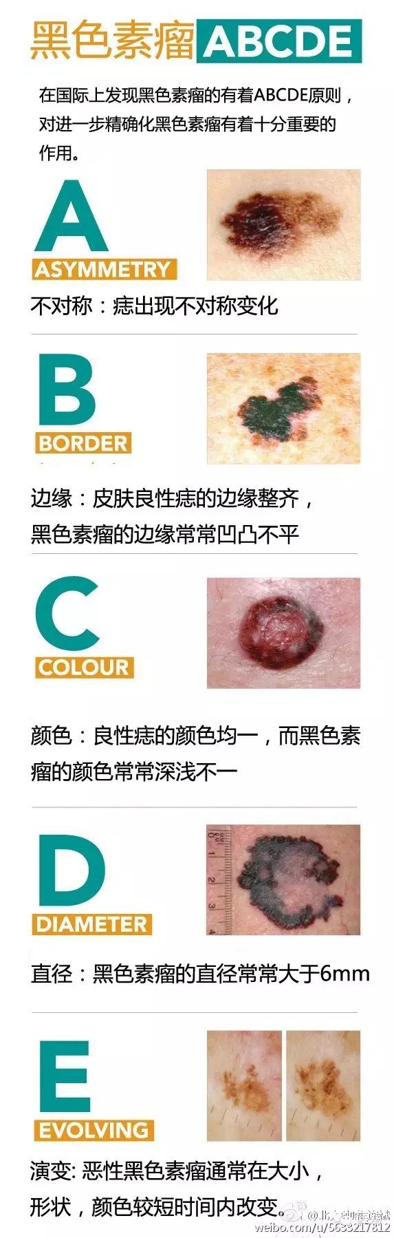 身上的大黑痣有可能癌变吗,身上的黑痣有药治吗