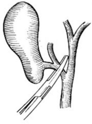我的胆囊切除经历,胆囊切除后腹泻多久能正常