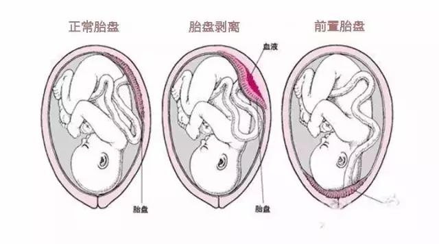 孕期产检不偷懒，关于前置胎盘的危害！