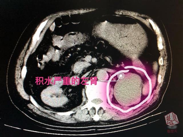 排石中药吃了一年多了,吃排石的药尿液浑浊黄