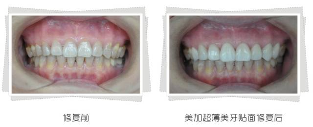 牙齿发黄让牙齿美白几个小妙招,牙齿不白笑容不好看