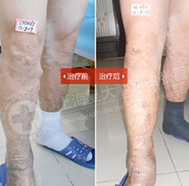 舌静脉曲张的症状及危害,外阴静脉曲张有什么症状