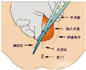 顺产什么情况需要会阴侧切?