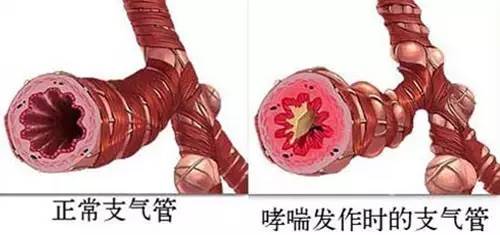 孩子咳嗽喘就一定是细菌感染吗,孩子老是咳嗽是不是支原体感染