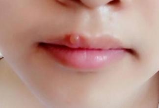 嘴唇上火留的黑印子怎么办,上火嘴唇长泡会留印吗