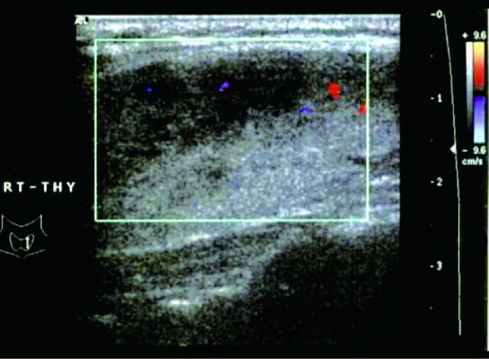 桥本氏甲状腺炎与亚急性甲状腺炎,亚急性甲状腺炎b超下的影像显示