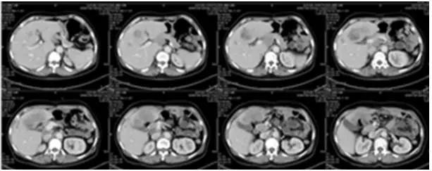 晚期胃癌治疗的思路与误区,晚期胃癌的成功治愈病例