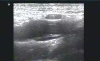 主动脉夹层动脉瘤如何检查和防治,主动脉夹层动脉瘤的超声表现