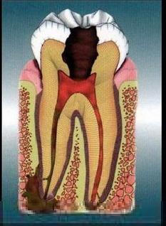 老年人蛀牙很厉害建议拔牙吗,蛀牙快到牙根了需要根管治疗吗