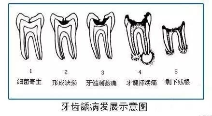 老年人蛀牙很厉害建议拔牙吗,蛀牙快到牙根了需要根管治疗吗