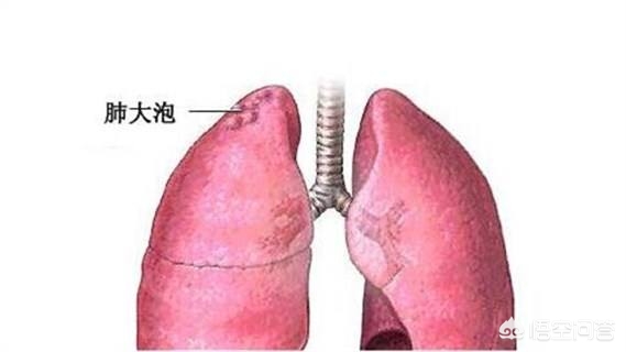 肺大泡不可以用力屏气不能提拉重物,可能导致其增大甚至破裂