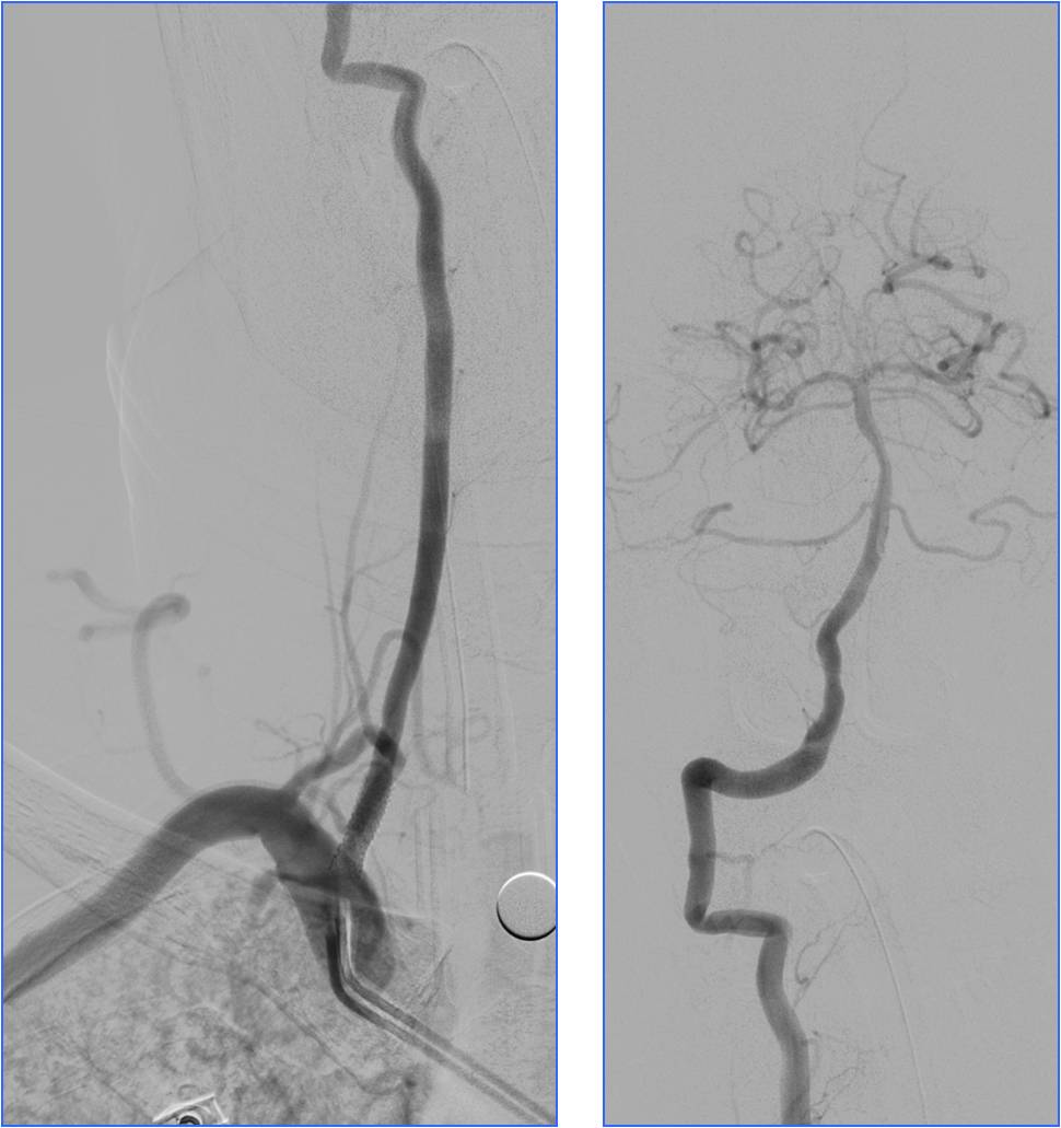 缺血性脑卒中术后管理,急性缺血性脑卒中血管内治疗