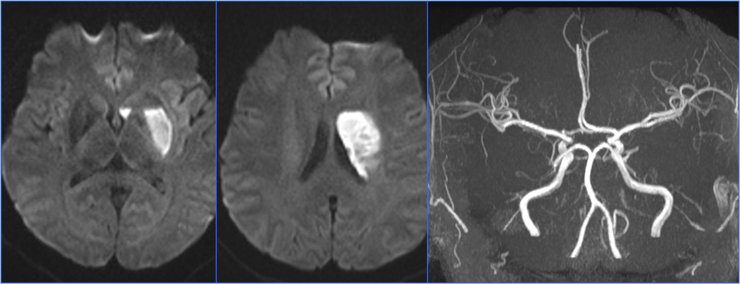缺血性脑卒中术后管理,急性缺血性脑卒中血管内治疗
