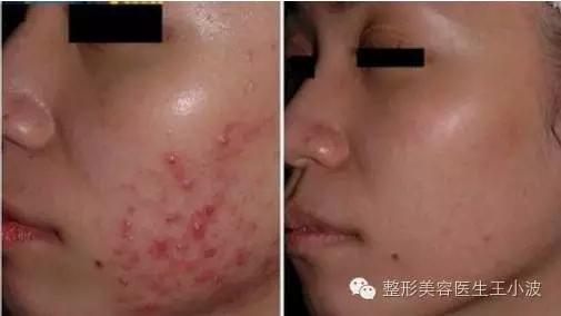 疮疡的病怎样治疗,疮疡是什么病引起的