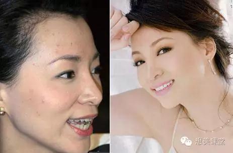 脸再美妆再浓，一颗痘痘毁你容！