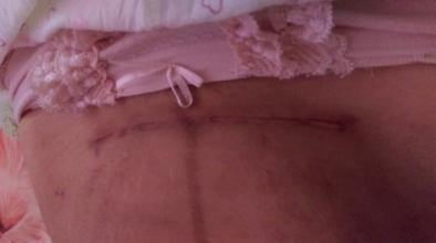 切口愈合发痒是怎么回事?该怎么办?