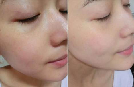 消除敏感性红血丝方法,敏感红血丝怎么修复最好