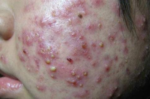 长痘最好的办法就是不要碰它,各种痘对应解决方法