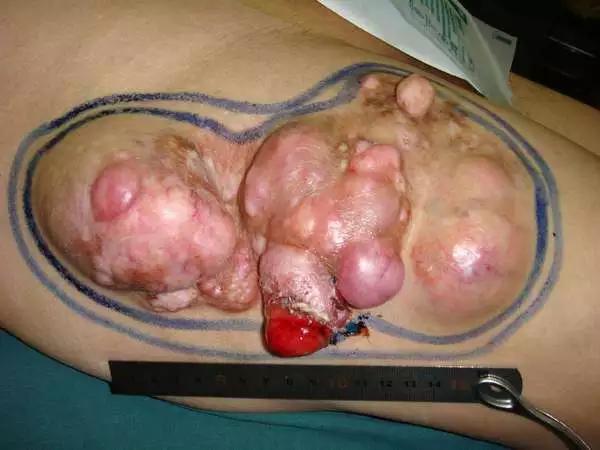 肉瘤良性和恶性误诊大不大,肉瘤为什么误诊为息肉