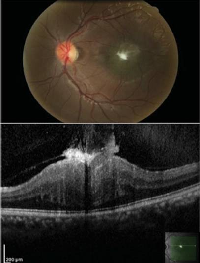文摘速递儿童视网膜前膜手术的长期疗效