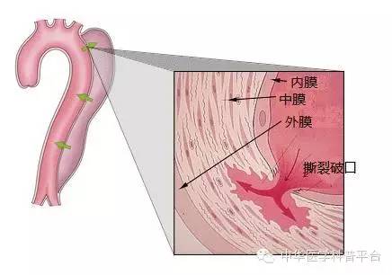 主动脉夹层什么症状,心脏主动脉夹层破裂