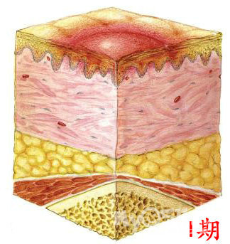 褥疮的护理和治疗方法,褥疮最怕的克星