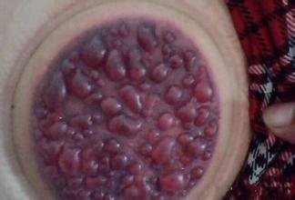 拔罐出现水泡要挑破吗,为什么拔罐会有水珠