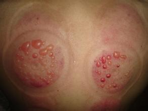 拔罐拔出血泡要不要戳破,为什么拔罐出水泡