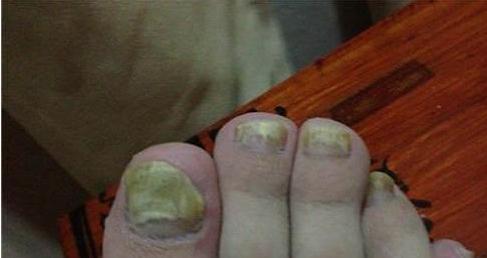 灰指甲是什么?哇，一看也吓一跳，危害这么多