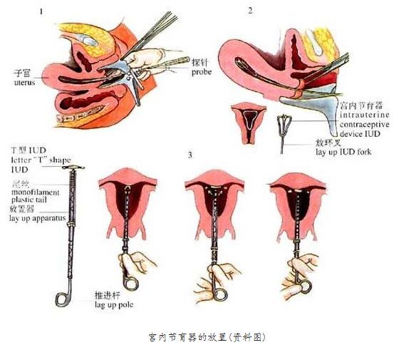 女性被逼在子宫腔内上环：不人性化，对女性的摧残！