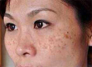 怀孕脸上长了一块黑斑怎么回事,怀孕了脸上长黑斑怎么回事