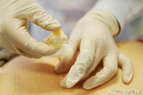 穴位埋线疗法,埋线治什么病