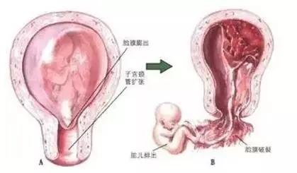 子宫颈内口松弛会造成不孕吗,宫颈内口松弛流产几率