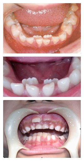 小孩长两层牙齿是怎么回事啊,孩子长两颗牙是什么原因