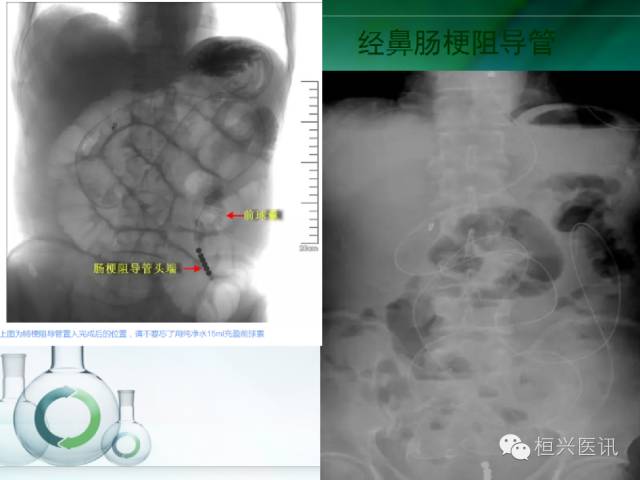 北京协和医院治疗肠梗阻的专家,恶性肠梗阻专家